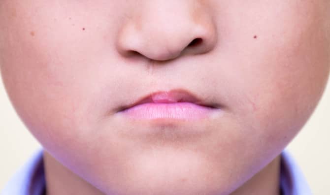 Smile Train Brings Big Grins to Children’s Faces