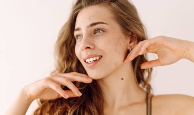 A woman with no makeup and red spots on her face.