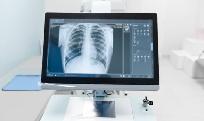 A chest X-ray on a medical monitor.